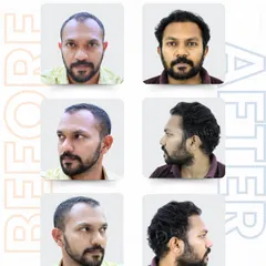 Here you can see Mr. Mithun’s transformation from every angle. Notice how the restored hairline and crown coverage blend perfectly, creating a seamless and natural profile. This is the result of meticulous planning and precise execution.