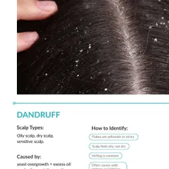 This is what true dandruff often looks like. The flakes are typically yellowish or sticky, and the scalp may feel oily. This condition is caused by an overgrowth of yeast and requires a specific treatment plan to manage oil production and reduce irritation.