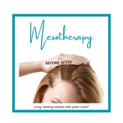My Mesotherapy treatment is a proven solution for hair thinning. This graphic shows the kind of hairline restoration and density improvement you can expect.
