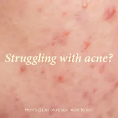 If you are struggling with persistent acne, you are not alone. It's a common condition that requires a professional, evidence-based approach for effective management.