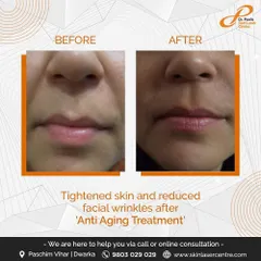 This before and after shows how cosmetic fillers can soften facial wrinkles around the nose and mouth. This anti-aging treatment restores volume for a naturally youthful and refreshed look.