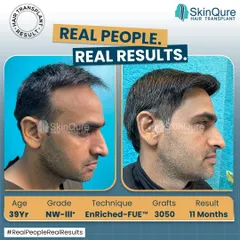 At 39 years old, this patient had Norwood Grade III hair loss. With 3050 grafts using the EnRiched-FUE technique, we restored his hairline and added density. The 11-month result shows a mature, natural hairline that is both age-appropriate and full.