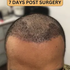 7 days post-surgery. The initial healing is progressing well, and the short, transplanted hairs are settling in. Scabbing is minimal and starting to clear.