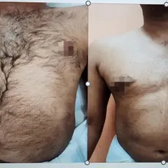 This before and after image shows the results of laser hair reduction on the chest for a male patient after just a few sessions. My advanced dual-wavelength laser offers effective and comfortable hair reduction for various skin and hair types, for both men and women.