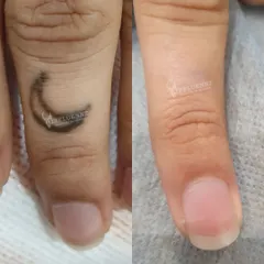 A complete and clear result. This before and after shows the full removal of a dark ink tattoo from a finger after completing the required sessions. The skin is left clear and undamaged, showing the effectiveness of a properly administered Pico Laser treatment plan.