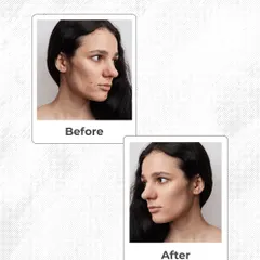 This before-and-after photo shows a successful pigmentation treatment. We erased the uneven patches and restored a clear, uniform skin tone for this patient, giving her a happy ending to her skin story.