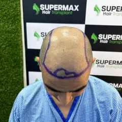 After shaving, the transplant area is clearly marked. This planning is crucial for a natural-looking hairline and density.