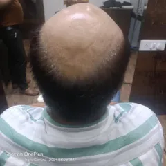 This is the 'before' photo of a client with advanced baldness on the crown. He was looking for an immediate and non surgical solution to restore his look.