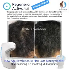 This patient saw a revitalized scalp and thicker hair just 2.5 months after a single session of Regenera Activa, supported by multivitamins. Our goal is to restore not just your hair, but your confidence too.