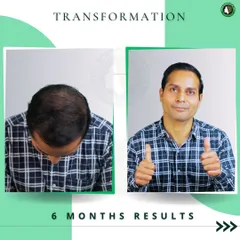Just six months post-procedure, and the results are already fantastic. This image shows significant new growth and density, demonstrating how quickly you can start enjoying the benefits of an FUE transplant.
