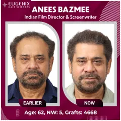 We are proud to be the choice of icons. Here is the remarkable transformation of esteemed Indian Film Director, Anees Bazmee. We addressed his Grade 5 hair loss with 4,668 grafts, creating a result that is as masterful as his films.