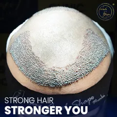 A clear view of a newly constructed hairline. The density is highest at the front and feathered slightly for a natural appearance. This meticulous placement is key to avoiding a "pluggy" or artificial look.