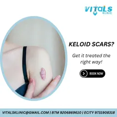 This graphic provides information on keloid scars, which are a form of abnormal scarring. I treat keloids with a multi-modal approach, often combining injections, laser therapy, and surgical removal for the best outcome.
