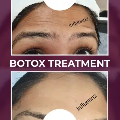 Forehead lines are a common concern, but the solution can be simple and effective. This before and after shows how Botox can smooth the skin for a refreshed and natural look, without freezing your expressions. The treatment is quick, taking about 15 minutes with no downtime.
