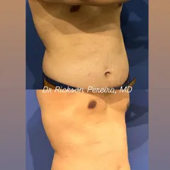 A side profile view of the same 44-year-old patient, showing a significant reduction in abdominal fat after 8 weeks. My program targets visceral and subcutaneous fat while maintaining muscle, which is crucial for longevity and preventing metabolic diseases like diabetes and hypertension.