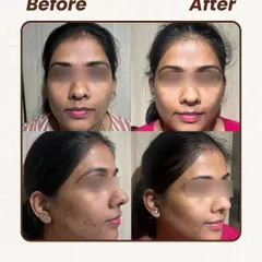 For this patient, we addressed a combination of scattered acne and uneven skin texture. A series of gentle peels and a consistent skincare routine helped smooth her skin and reduce the frequency of breakouts, leading to a clearer and more radiant complexion.