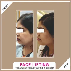 Another angle of the same client, showing the consistent and impressive face lifting results from our in-motion HIFU treatment. It's an excellent option for enhancing natural curves and achieving a toned silhouette without surgery.