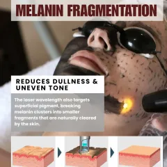 The laser also works deeper to break up superficial melanin clusters. This process of melanin fragmentation helps reduce dullness and uneven skin tone, leading to a brighter complexion over time.