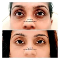 This transformation shows the power of under-eye fillers. The treatment effectively corrected the sunken appearance, making the eyes look brighter and more youthful.