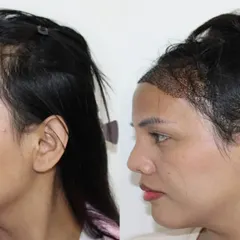 The profile view demonstrates the new, lower starting point of the hairline. I take great care to create a soft, irregular line that mimics natural female hairlines.