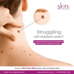 This graphic advertises my advanced wart removal treatment as a quick and effective solution for those struggling with stubborn warts, ensuring clear and smooth skin.