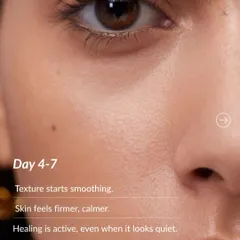 Day 4-7 after microneedling: You'll notice your skin's texture starting to smooth out as it feels firmer and calmer. The healing process is actively working, even when the surface looks quiet.