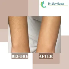See the difference laser hair reduction can make on the arms. The 'before' image shows dense hair growth, while the 'after' image displays smooth, hair-free skin, demonstrating the effectiveness of targeting hair at the follicle level for long-lasting results.