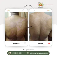 Here you can see the transformative results of my Ayurvedic treatment for a chronic skin condition on the back. My holistic approach focuses on addressing the root cause of skin issues, leading to lasting relief and visibly healthier skin.