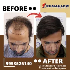 A comprehensive transformation achieved with 4830 grafts. This before-and-after comparison highlights the complete restoration of the hairline and crown area, demonstrating what is possible even with advanced hair loss.