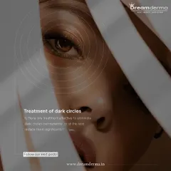 Are you looking for an effective treatment to eliminate or significantly reduce dark circles? We have the expertise to transform tired eyes into vibrant ones. Follow our page for more information on our solutions.