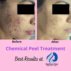 A before and after look at the results of chemical peel treatments for active acne and marks. After just two sessions, you can see a considerable reduction in inflammation and fading of post-acne pigmentation.