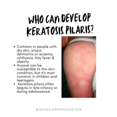 Who gets Keratosis Pilaris? It's very common in people with dry skin, eczema, or a genetic predisposition. It often appears during childhood or adolescence and can worsen in winter.