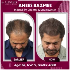 A complete view of Director Anees Bazmee's transformation from all angles, showing the density and natural hairline we created.