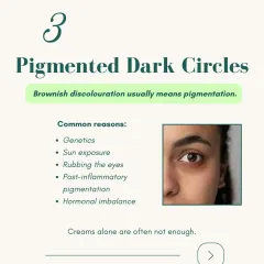 If you have brownish discoloration under your eyes, you likely have pigmented dark circles. These are often caused by genetics, sun exposure, or even hormonal imbalances, and creams alone are rarely enough to treat them.