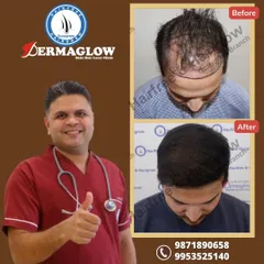 This client's result after an 11-month period involved the transplantation of 3200 grafts. The procedure effectively filled in the thinning crown and reinforced the hairline, leading to a much fuller head of hair.