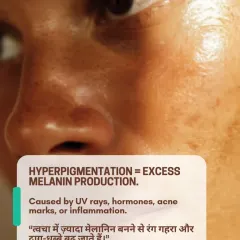 Hyperpigmentation is simply the overproduction of melanin, often caused by UV rays, hormones, or inflammation from acne. Understanding the cause is the first step toward an effective treatment plan.