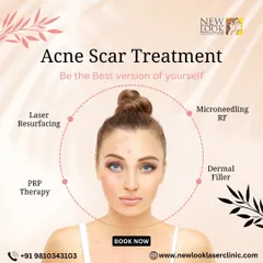 We offer a comprehensive range of solutions for acne scars, because no two skin types are the same. This visual outlines some of our most effective approaches, including Laser Resurfacing, Microneedling RF, PRP Therapy, and Dermal Fillers, all tailored to your specific needs after a thorough skin analysis.