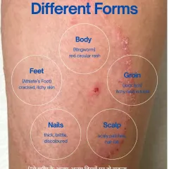 Fungal infections can appear in many different forms all over the body, from ringworm on the body to Athlete's Foot, Jock Itch, and even on the scalp and nails. Each requires specific care.