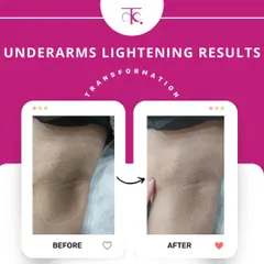 This is a real result from my underarm lightening treatment. Using a gentle, customized chemical peel, we can significantly reduce pigmentation over a few sessions, helping you feel confident enough to wear whatever you want. No harsh bleach, just a safe and effective process.
