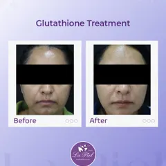Glutathione is a powerful antioxidant that I use to help brighten the skin and improve its overall tone. This before-and-after shows how the treatment can contribute to a more luminous and even complexion by reducing oxidative stress in the skin.