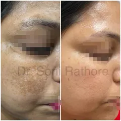 This before and after image showcases a significant reduction in melasma. We achieved this result through a multi-faceted approach including prescription creams, a series of chemical peels for pigmentation, and targeted laser treatments.