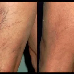 This before-and-after shows the successful treatment of spider veins on the legs using microsclerotherapy. This minimally invasive procedure involves injecting a solution that causes the small veins to collapse and fade away over time.