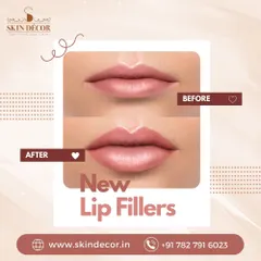 A before and after look at the subtle, natural enhancement achieved with our new lip fillers. My goal is always to restore balance and volume for a result that boosts confidence while looking like you.
