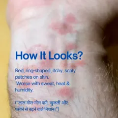 This is what a typical fungal infection, or ringworm, looks like: red, ring shaped, itchy, and scaly patches that often get worse with sweat and heat.