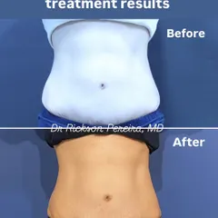 This before and after showcases the targeted fat reduction possible with our Wonder Prestige treatment. This non-invasive technology helps sculpt the abdomen by stimulating intense muscle contractions, leading to a reduction in subcutaneous fat and a more toned appearance, all without downtime.