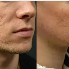 For this male patient, MNRF was used to significantly reduce the depth of acne scars and improve overall skin texture. This treatment rebuilds the skin from within for lasting results.
