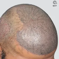 A look at the scalp just after surgery for a Grade 6 case. 5700 grafts were meticulously placed in a single session to recreate the hairline and add density from the frontal area to the crown.