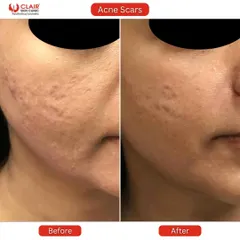 This before and after photo highlights the successful treatment of rolling acne scars on the cheek and jawline. The skin is visibly smoother and the shadows cast by the indentations are significantly diminished.