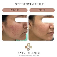 Every skin transformation requires patience and trust in the process. This patient's progress shows a remarkable reduction in redness and active acne, leading to clearer and healthier-looking skin over time.