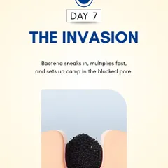 Day 7: Bacteria that naturally live on the skin find their way into the clogged pore. Here, they multiply quickly, creating an environment for inflammation.